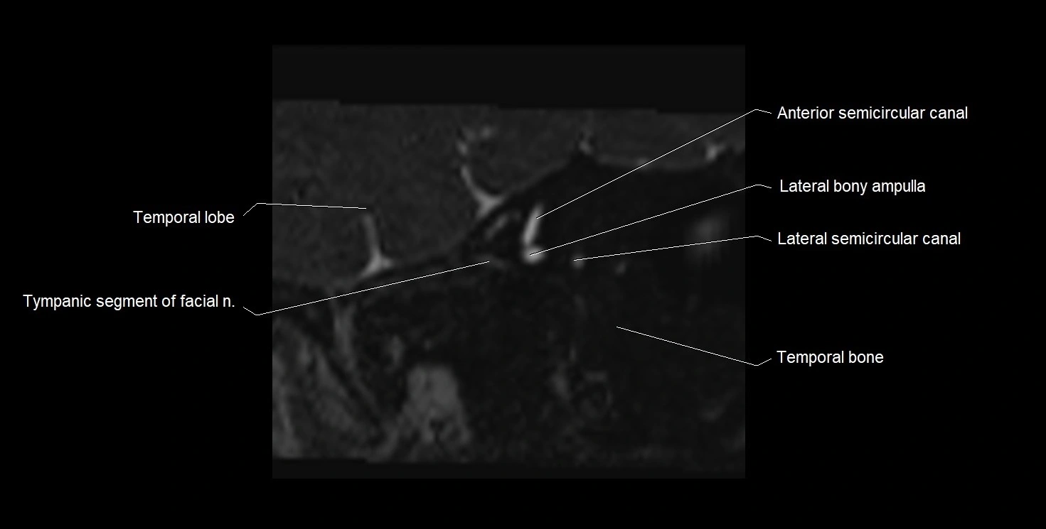 Internal auditory meatus (IAM) 3T sagittal cross sectional anatomy image 4.webp